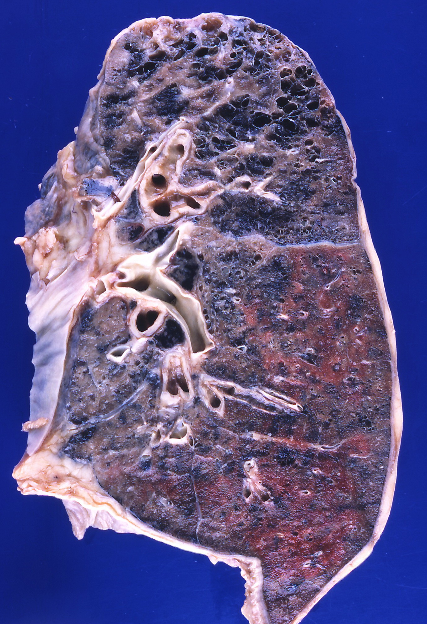 Gross upper-lobe centriacinar emphysema with enlarged central airspaces