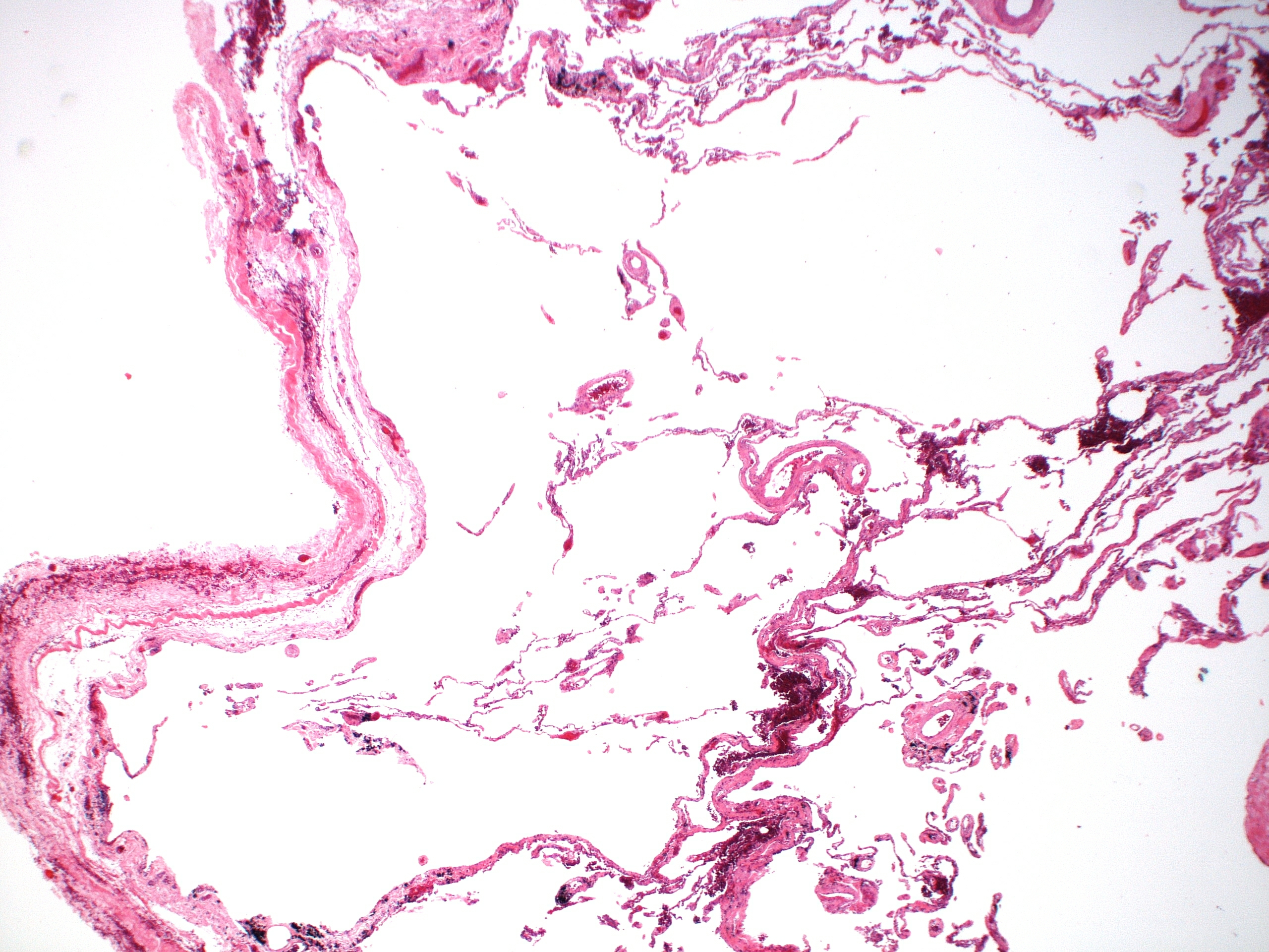 Panacinar emphysema showing uniform enlargement throughout pulmonary acini